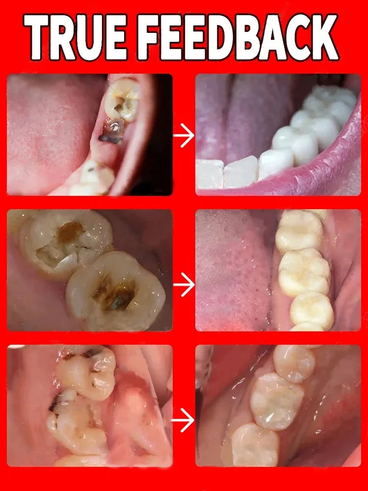 Teeth whitening anti-cavity Toothpaste