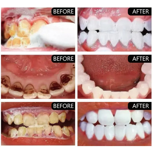 5 Days Teeth Whitening Toothpaste