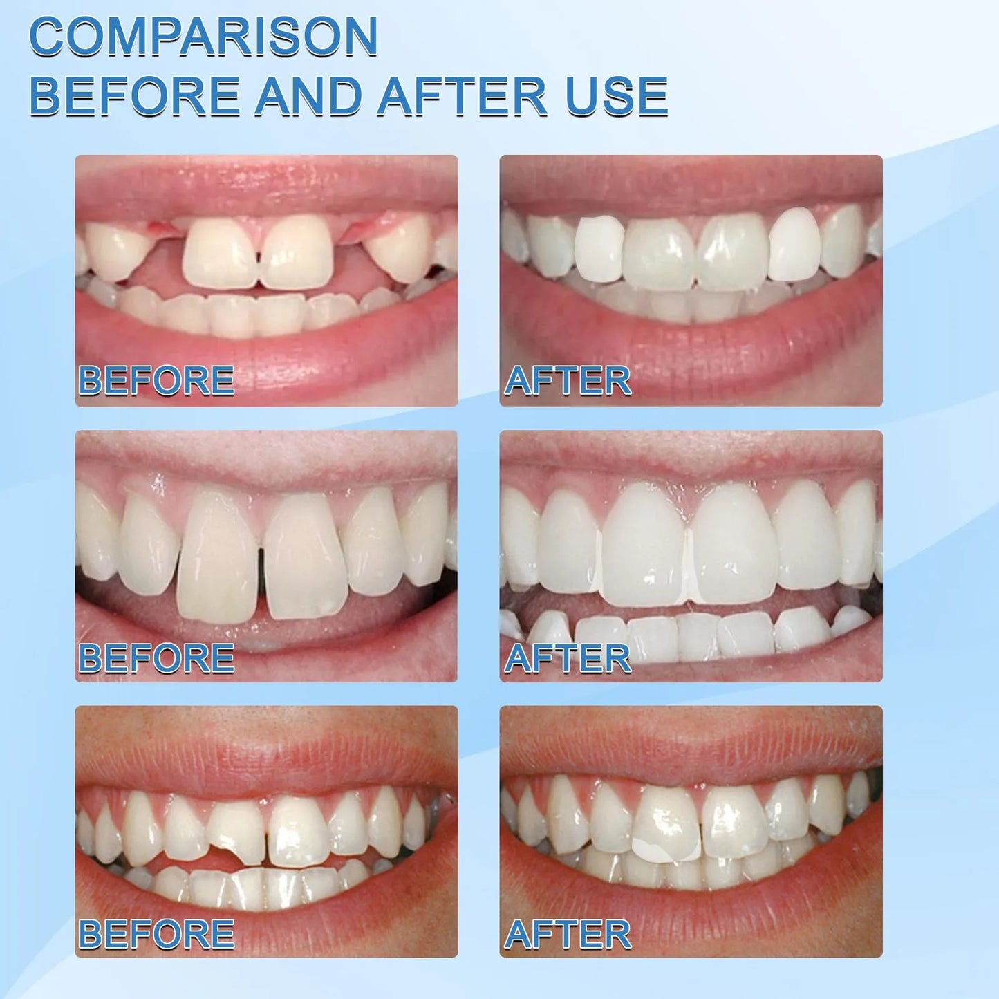 Moldable Temporary Tooth Repairing Whitening Kit