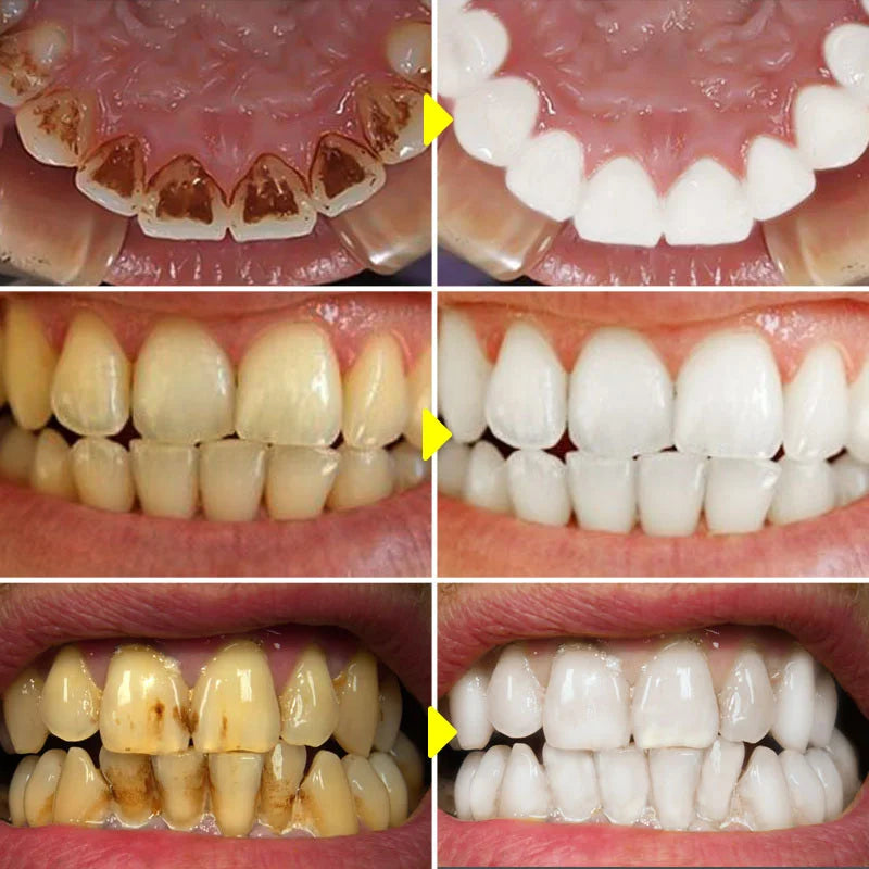 Teeth Whitening Essence Remove